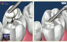 Công nghệ tái tạo răng - Bước nhảy vọt trong lĩnh vực nha khoa