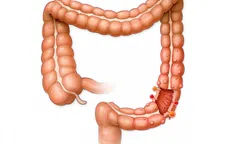 Ruột thừa không hề... thừa