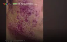 Độc hại là thế, sao corticoid vẫn được sử dụng trong mỹ phẩm?