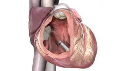 Mỹ: Cấy ghép máy tạo nhịp tim nhỏ nhất thế giới