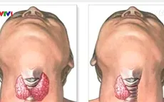 Ung thư tuyến giáp – căn bệnh có thể chữa khỏi