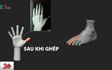 Kỹ thuật cấy ghép ngón chân thành ngón tay cái