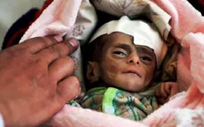Trẻ em Yemen suy dinh dưỡng nghiêm trọng