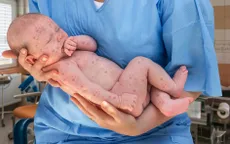 Báo động số ca bệnh sởi tăng nhanh chóng tại Israel