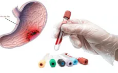 Các bước tầm soát ung thư dạ dày ai cũng cần biết