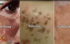 Điều trị nám da ở phụ nữ