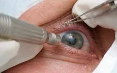 Sau phẫu thuật đục thủy tinh thể, mắt cần chăm sóc thế nào?