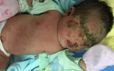 Trẻ 1 tháng tuổi viêm da chảy mủ toàn thân do tắm lá cây