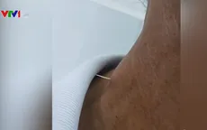 Hãi hùng xương cá đâm xuyên thực quản cụ ông 61 tuổi