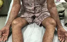 Tự ý dùng thuốc trị bệnh gout, cụ bà bị đỏ da toàn thân
