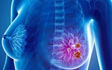 Các dấu hiệu tái phát di căn bệnh ung thư vú