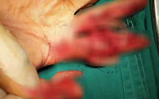 Dập nát bàn tay do máy thái thịt