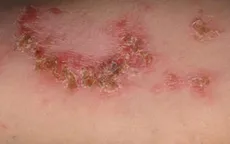 Bệnh chốc ở trẻ em có nguy hiểm?