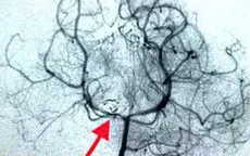 Một bé gái 3 tuổi bị vỡ phình mạch não