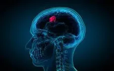 Dấu hiệu cảnh báo bạn có thể mắc căn bệnh u não