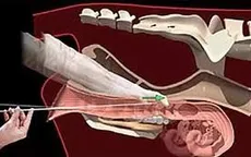 Quy trình thực hiện chọc hút trứng có đau không?