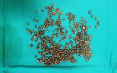 Đến bác sĩ cũng ngỡ ngàng vì gắp mãi không hết sỏi trong túi mật bệnh nhân