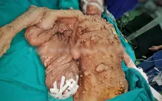 Phẫu thuật giải phóng "cánh đại bàng" bám chặt cơ thể một phụ nữ suốt 40 năm
