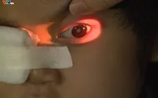 Nguy cơ đục thủy tinh thể suốt đời do lạm dụng thuốc corticoid