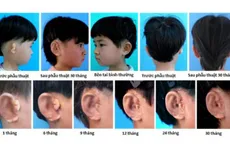 Trung Quốc nuôi và cấy ghép thành công tai từ tế bào sụn