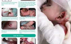 Gian nan hành trình chăm sóc trẻ bị ly thượng bì bóng nước