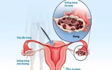 Hội chứng đa nang buồng trứng
