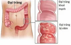 Nếu có các dấu hiệu này, cần đi khám đại tràng ngay