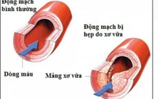 Xơ vữa động mạch: Cảnh giác với đột quỵ