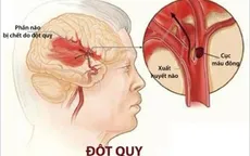 Dự phòng đột quỵ não như thế nào?