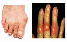 Ăn gì khi bị bệnh gout?