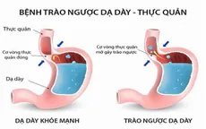 Cẩn trọng: Đồ uống có cồn gây bệnh trào ngược dạ dày - thực quản