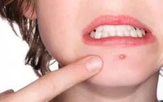 Không chủ quan với nhọt vùng cổ, mặt