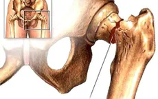 Nhiều người tự làm mình tàn phế mà không hay biết