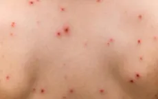 Đắk Lắk: Ghi nhận 2 ổ dịch thủy đậu tại huyện Lắk và TP. Buôn Ma Thuột