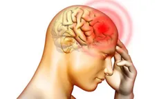 Dị dạng mạch máu não làm tăng tỷ lệ đột quỵ ở người trẻ tuổi
