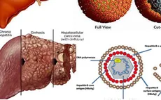 Gần 70% ca ung thư gan có nhiễm virus viêm gan B