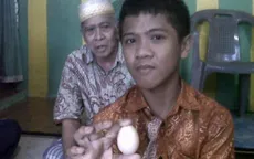 Ly kỳ câu chuyện cậu bé người Indonesia "đẻ" trứng trong hai năm