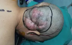 Phối hợp liên khoa phẫu thuật thành công khối u vùng chẩm hiếm gặp