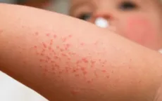 Các bệnh về da thường gặp trong mùa hè và cách phòng chống