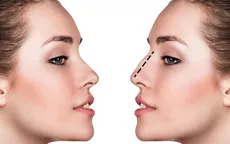 Những điều cần biết về phẫu thuật thẩm mỹ mũi
