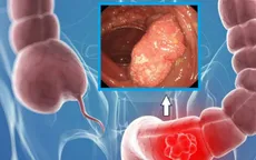 Rối loạn tiêu hóa, đi ngoài phân lỏng - phát hiện ung thư
