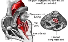 Cứu sống mẹ con sản phụ bị bệnh tim nặng kèm theo khối u xơ tử cung nặng 4kg