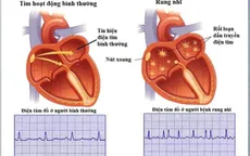 Rung nhĩ: Những điều người bệnh tim cần biết