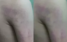 Kỷ luật cô giáo đánh bầm tím học sinh lớp 1