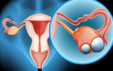 10 dấu hiệu khiến bạn nghĩ đến ung thư buồng trứng