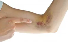 Dấu hiệu ung thư máu không nên bỏ qua