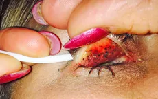 Nguy cơ mù do không tẩy trang mascara
