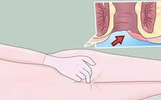 Đừng nhầm bệnh trĩ với ung thư hậu môn