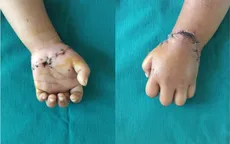 Nối thành công bàn tay đứt rời cho bé gái 31 tháng tuổi