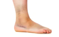 Có nên bôi dầu nóng khi bị bong gân?